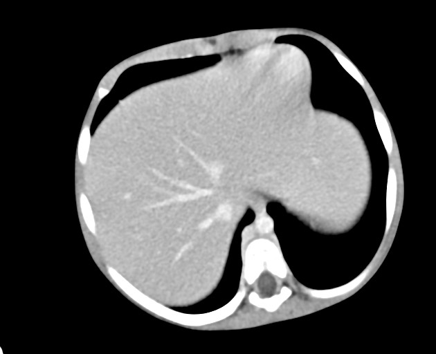 Abdominopelvic rhabdomyosarcoma (Radiopaedia 78356-90984 Axial C+ portal venous phase 40).jpg