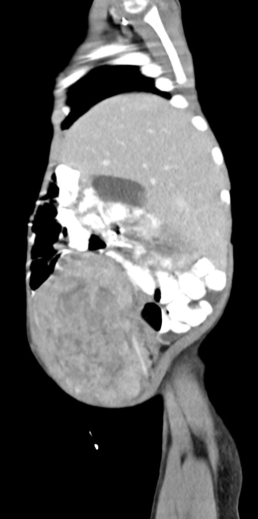 Abdominopelvic rhabdomyosarcoma (Radiopaedia 78356-90984 Sagittal C+ portal venous phase 82).jpg