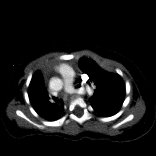 Aberrant left pulmonary artery (pulmonary sling) (Radiopaedia 42323-45435 Axial C+ CTPA 18).jpg