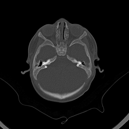 File:Accessory intraparietal suture (Radiopaedia 50584-56020 Axial bone window 8).jpg
