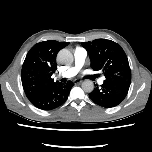 Accessory left horizontal fissure with lingular pneumonia (Radiopaedia 53763-59843 Axial C+ CTPA 45).jpg