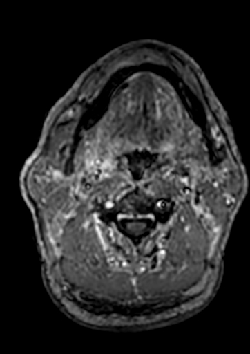 Accessory middle cerebral artery (Radiopaedia 73114-83828 Axial T1 C+ 292).jpg