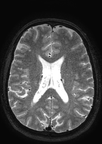 Accessory middle cerebral artery (Radiopaedia 73114-83828 Axial T2 34).jpg