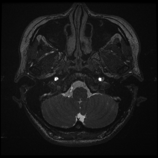 File:Acoustic neuroma (Radiopaedia 34049-35283 Axial 14).png