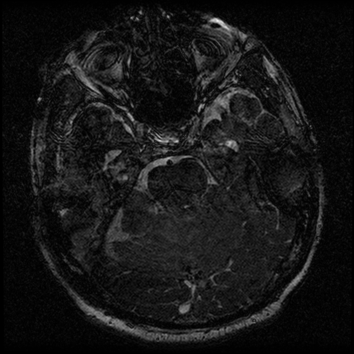File:Acoustic schwannoma (Radiopaedia 39170-41387 Axial FIESTA 95).png