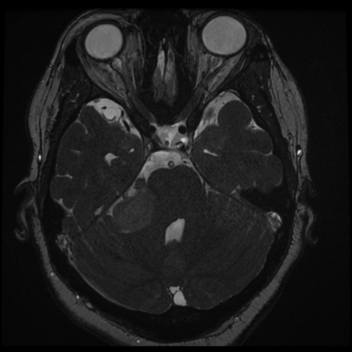 Acoustic schwannoma (Radiopaedia 57574-64536 Axial T2 57).png