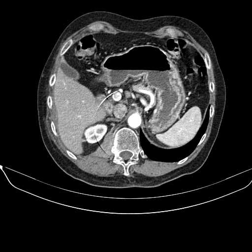 File:Acquired adrenal hyperplasia - due to thymic carcinoid tumor (Radiopaedia 21269-21184 C+ arterial phase 27).jpg