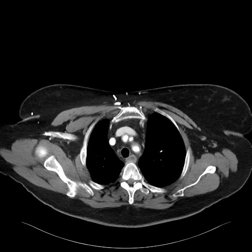 Acromioclavicular joint cyst (Radiopaedia 58455-65610 Axial C+ arterial phase 35).jpg