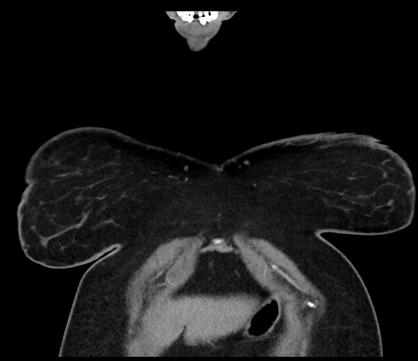 Acromioclavicular joint cyst (Radiopaedia 58455-65610 Coronal C+ arterial phase 21).jpg