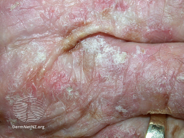 File:Actinic keratoses affecting the hands (DermNet NZ lesions-ak-hands-382).jpg
