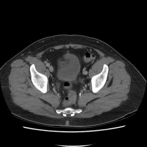 File:Active colonic bleed on CT (Radiopaedia 49765-55025 Axial C+ delayed 72).jpg