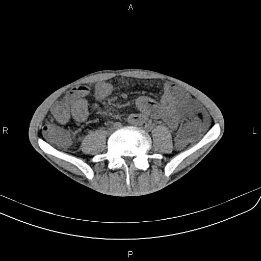 Active crohn disease (Radiopaedia 87133-103397 Axial non-contrast 65).jpg