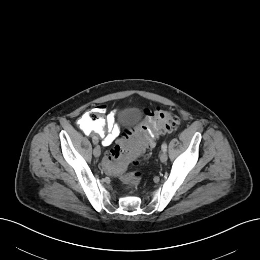 File:Active lower gastrointestinal bleeding - diverticular (Radiopaedia 61203-69106 Axial C+ portal venous phase 104).jpg
