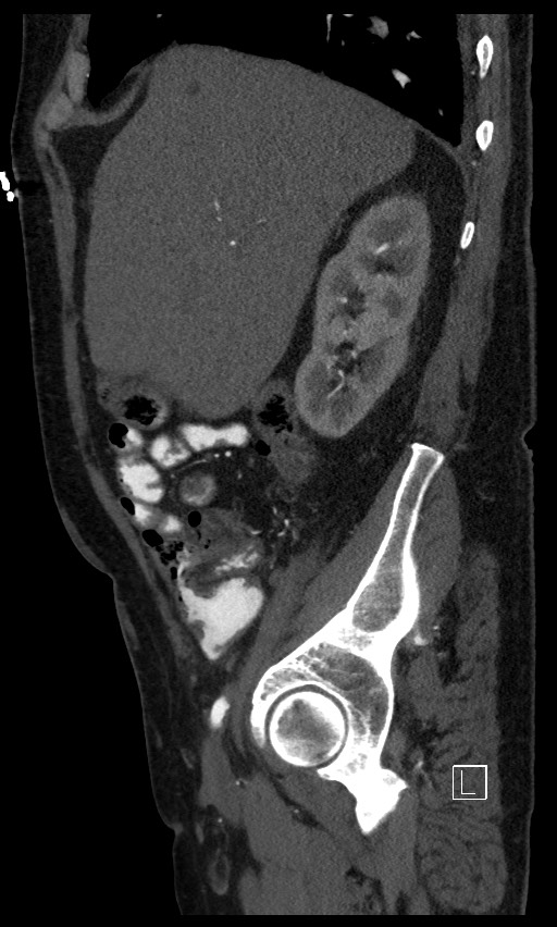 Active lower gastrointestinal bleeding - diverticular (Radiopaedia 61203-69106 Sagittal C+ arterial phase 117).jpg