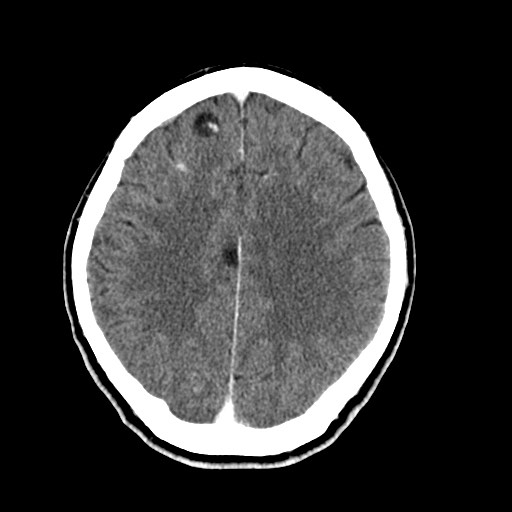 File:Active neurocysticercosis before and after therapy (Radiopaedia 71710-82099 Axial C+ delayed 30).jpg