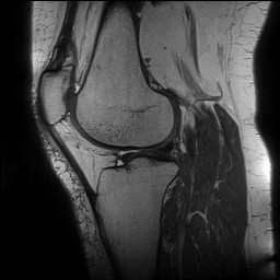 Acute-on-chronic transient lateral patellar dislocation with trochlear dysplasia (Radiopaedia 84099-99349 Sagittal PD 101).jpg