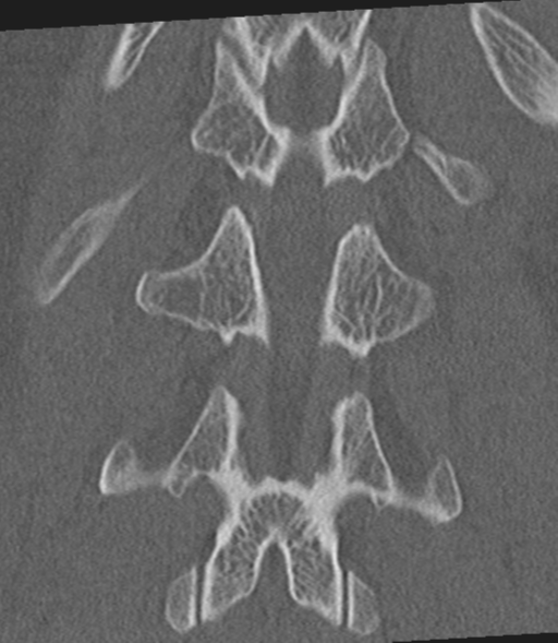 Acute L1 burst compression fracture (Radiopaedia 34430-35755 Coronal bone window 44).png