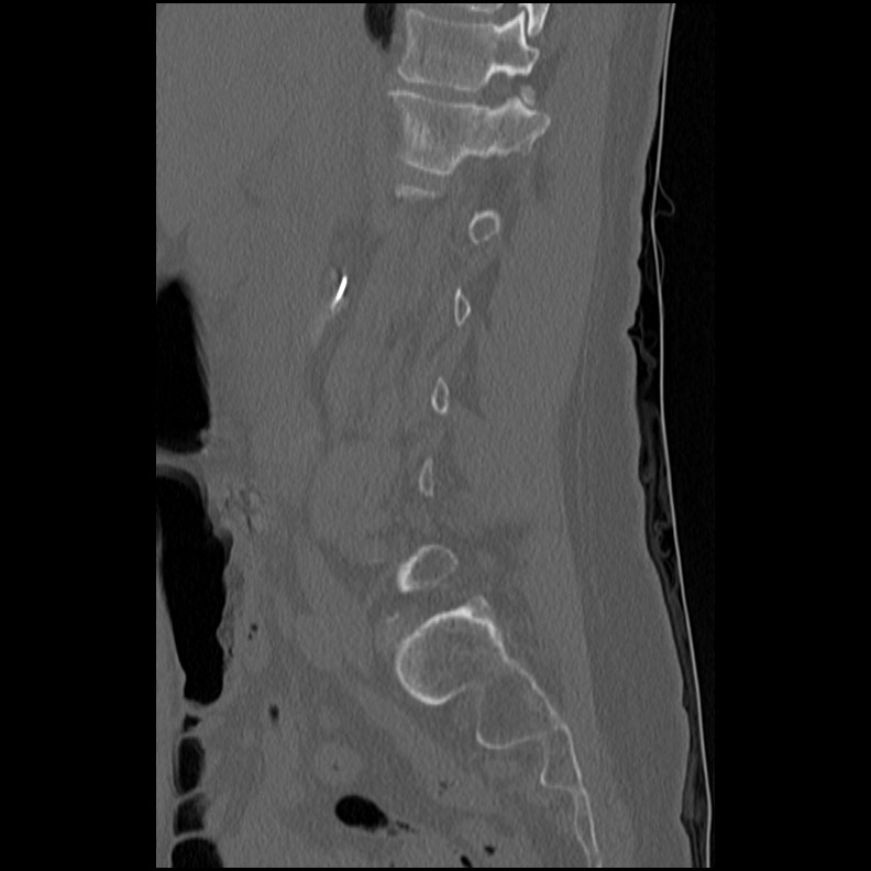 Acute Schmorl's node (Radiopaedia 83276-102365 Sagittal bone window 52).jpg