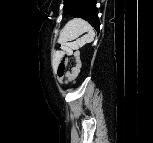 Acute appendicitis, heterotaxy syndrome (Radiopaedia 66884-76202 Sagittal C+ portal venous phase 108).jpg