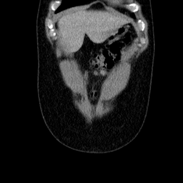 Acute appendicitis (Radiopaedia 38255-40270 Coronal C+ portal venous phase 15).jpg