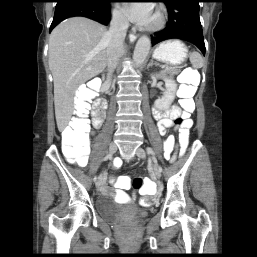 File:Acute appendicitis (Radiopaedia 52672-58589 Coronal C+ portal venous phase 67).jpg