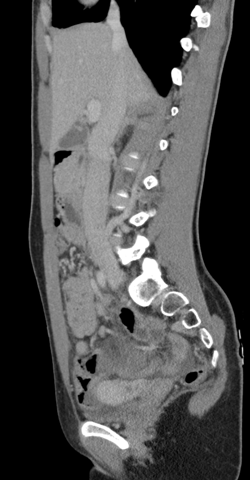 Acute appendicitis (Radiopaedia 62608-70901 Sagittal C+ portal venous phase 29).jpg