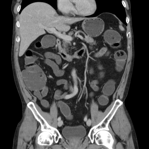 Acute appendicitis (Radiopaedia 66513-75790 Coronal C+ portal venous phase 34).jpg