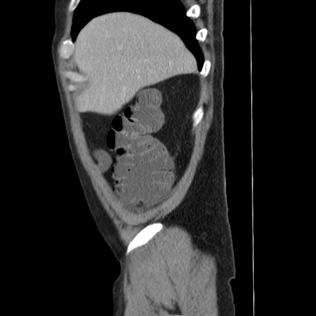 File:Acute appendicitis (Radiopaedia 66513-75790 Sagittal C+ portal venous phase 16).jpg