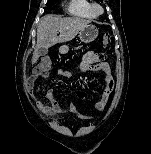 Acute appendicitis (Radiopaedia 79950-93224 Coronal C+ portal venous phase 23).jpg