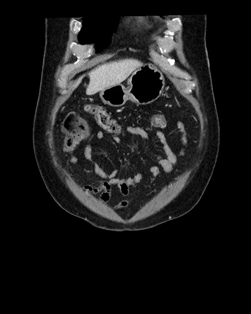 Acute appendicitis - large appendicoliths (Radiopaedia 61805-69820 Coronal C+ portal venous phase 28).jpg