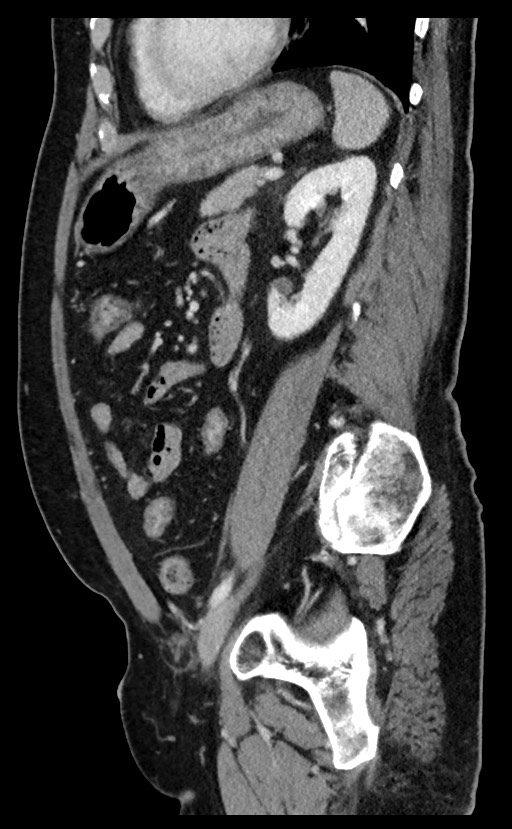 Acute appendicitis - large appendicoliths (Radiopaedia 61805-69820 Sagittal C+ portal venous phase 39).jpg