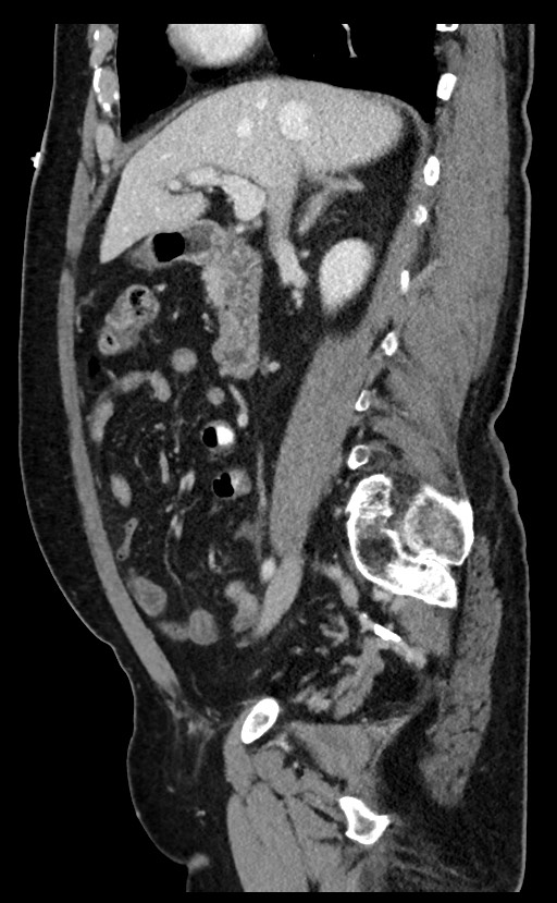 Acute appendicitis - large appendicoliths (Radiopaedia 61805-69820 Sagittal C+ portal venous phase 72).jpg