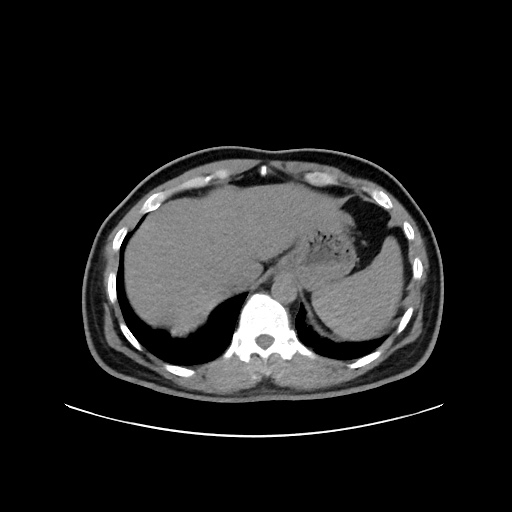 File:Acute appendicitis and COVID 19 pneumonia (Radiopaedia 76604-88380 Axial non-contrast 50).jpg