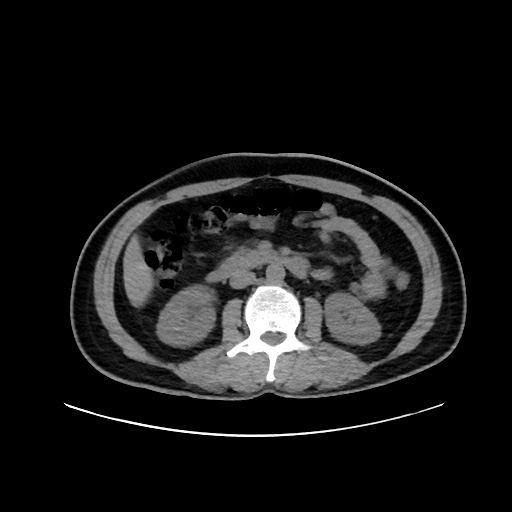 Acute appendicitis and COVID 19 pneumonia (Radiopaedia 76604-88380 Axial non-contrast 72).jpg