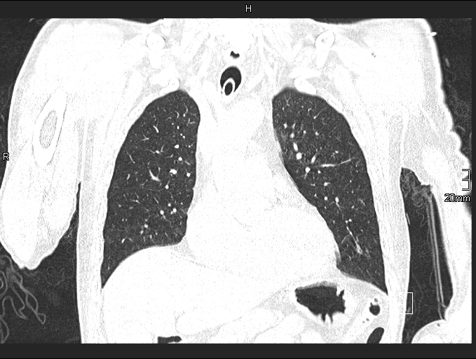 Acute aspiration pneumonitis (Radiopaedia 55642-62166 Coronal lung window 34).jpg