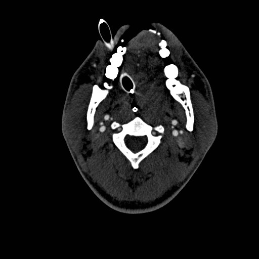 Acute basilar artery occlusion (Radiopaedia 43582-46985 Axial C+ arterial phase 142).jpg