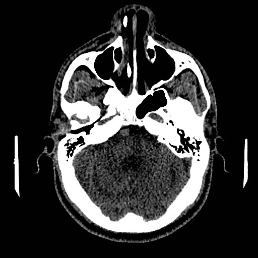 Acute basilar artery occlusion (Radiopaedia 43582-46985 Axial non-contrast 55).jpg