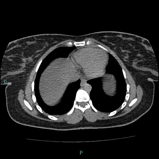 Acute bilateral pyelonephritis (Radiopaedia 37146-38881 Axial non-contrast 4).jpg