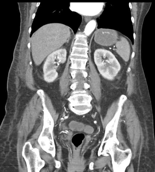 File:Acute bleed from gastric fundus biopsy site (Radiopaedia 35201-36737 D 37).png