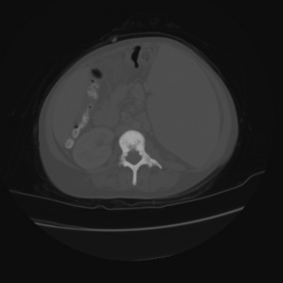 Acute calculous cholecystitis in patient with osteopetrosis (Radiopaedia 77871-90159 Axial bone window 26).jpg