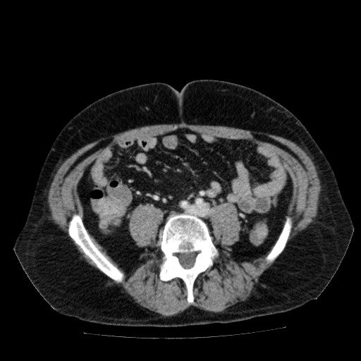 Acute cholecystitis and incidental left sided IVC (Radiopaedia 49352-54459 Axial C+ portal venous phase 99).jpg