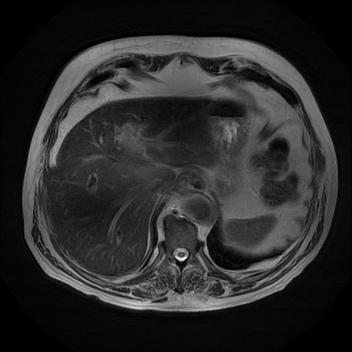 File:Acute cholecystitis complicated by pylephlebitis (Radiopaedia 65782-74915 Axial T2 9).jpg