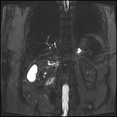 File:Acute cholecystitis with gallbladder neck calculus (Radiopaedia 42795-45971 Coronal Turbo spin echo 40).jpg
