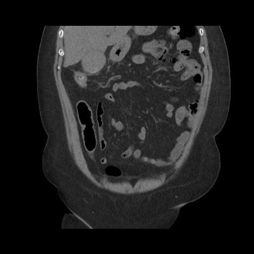 Acute cholecystitis with tensile fundus sign (Radiopaedia 71394-81723 Coronal non-contrast 47).jpg