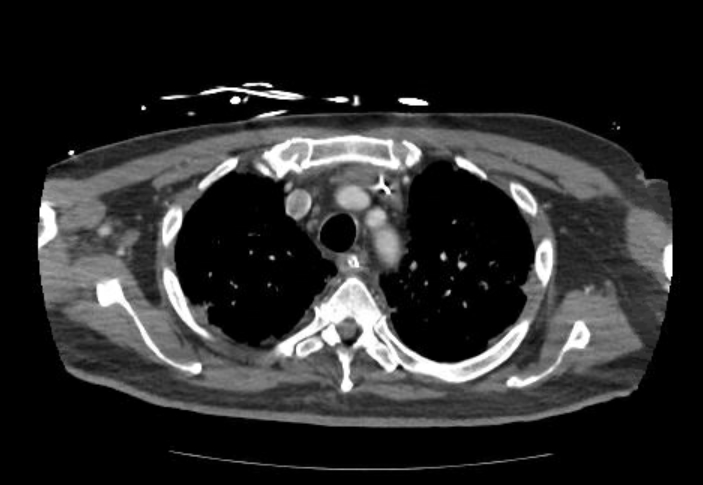 File:Acute cor pulmonale (ultrasound) (Radiopaedia 83508-98818 Axial C+ CTPA 14).jpg