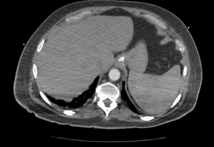 Acute cor pulmonale (ultrasound) (Radiopaedia 83508-98818 Axial C+ CTPA 76).jpg