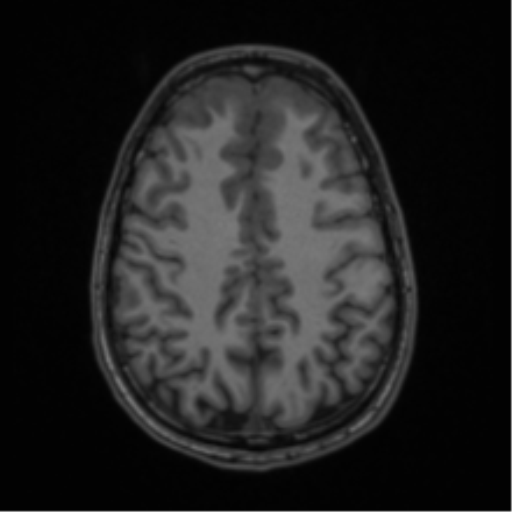 Acute disseminated encephalomyelitis (ADEM) (Radiopaedia 65319-74349 Axial T1 49).png
