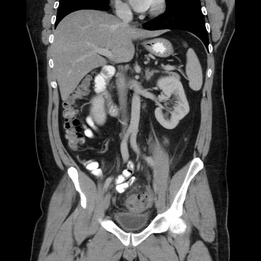 Acute diverticulitis with localized perforation (Radiopaedia 41296-44113 Coronal C+ portal venous phase 33).jpg