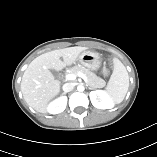 Acute gangrenous appendicitis with perforation (Radiopaedia 40152-42662 Axial C+ portal venous phase 19).png