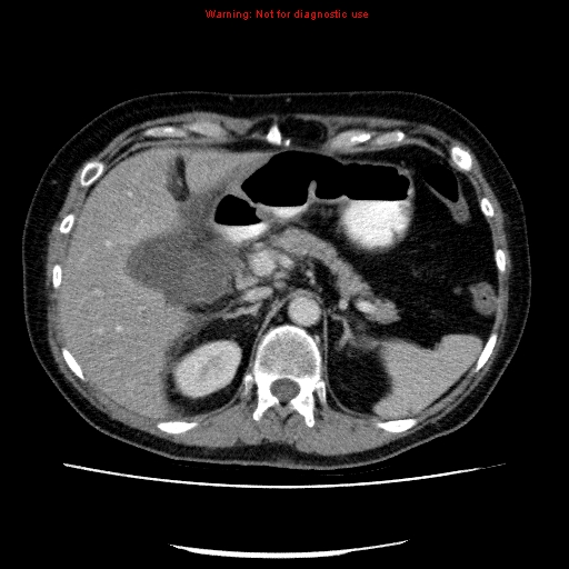 Acute gangrenous cholecystitis (Radiopaedia 10123-10661 Axial C+ portal venous phase 28).jpg